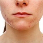 Mejores tratamientos para las cicatrices del acné