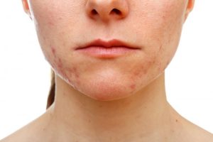 Mejores tratamientos para las cicatrices del acné